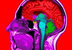 Study Identifies Area Postrema Syndrome Identification Criteria in NMOSD Study Identifies Area Postrema Syndrome Identification Criteria in NMOSD