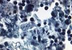 Tap Water in Neti Pot Linked to Brain Infection, Death From <i> Balamuthia mandrillaris </i> Tap Water in Neti Pot Linked to Brain Infection, Death From <i> Balamuthia mandrillaris </i>