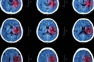 Researchers found that intravenous alteplase can inhibit poststroke ischemic brain lesions or at least delay their progression. Researchers found that intravenous alteplase can inhibit poststroke ischemic brain lesions or at least delay their progression.