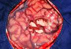 Postresection Monitoring May Provide Further Insights on Epileptogenic Zone Following Multistage Epilepsy Surgery Postresection Monitoring May Provide Further Insights on Epileptogenic Zone Following Multistage Epilepsy Surgery