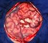 Postresection Monitoring May Provide Further Insights on Epileptogenic Zone Following Multistage Epilepsy Surgery Postresection Monitoring May Provide Further Insights on Epileptogenic Zone Following Multistage Epilepsy Surgery