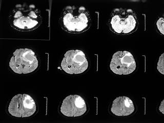 Standard therapy is more effective for female vs male patients with glioblastoma. Standard therapy is more effective for female vs male patients with glioblastoma.