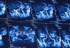 Risk for MCI Up With Progressive Cerebral Small Vessel Disease Risk for MCI Up With Progressive Cerebral Small Vessel Disease