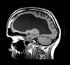 Hydrocephalus May Be a Complication of Congenital Zika Syndrome Hydrocephalus May Be a Complication of Congenital Zika Syndrome