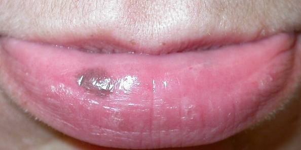 Labial Lentigo Labial Melanotic Macule   Ch1135.fig1 