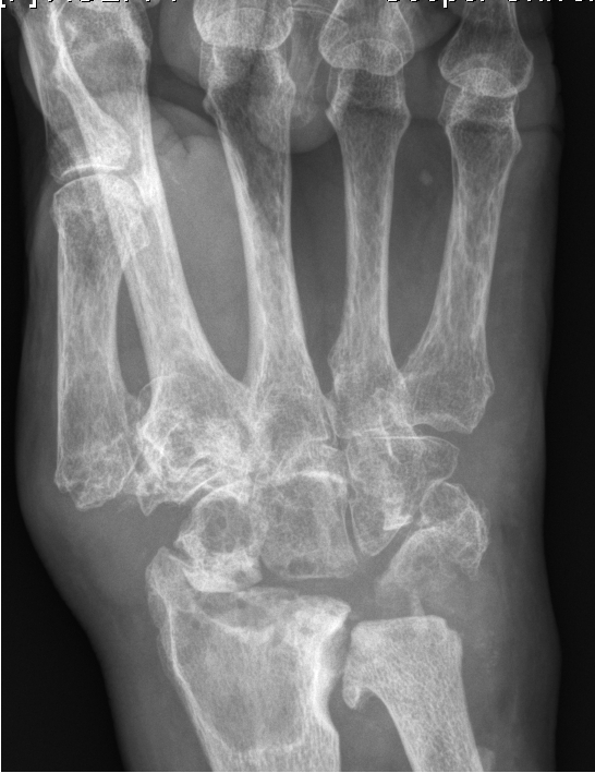 Pseudogout (Calcium Phyrophosphate Deposition Disease)