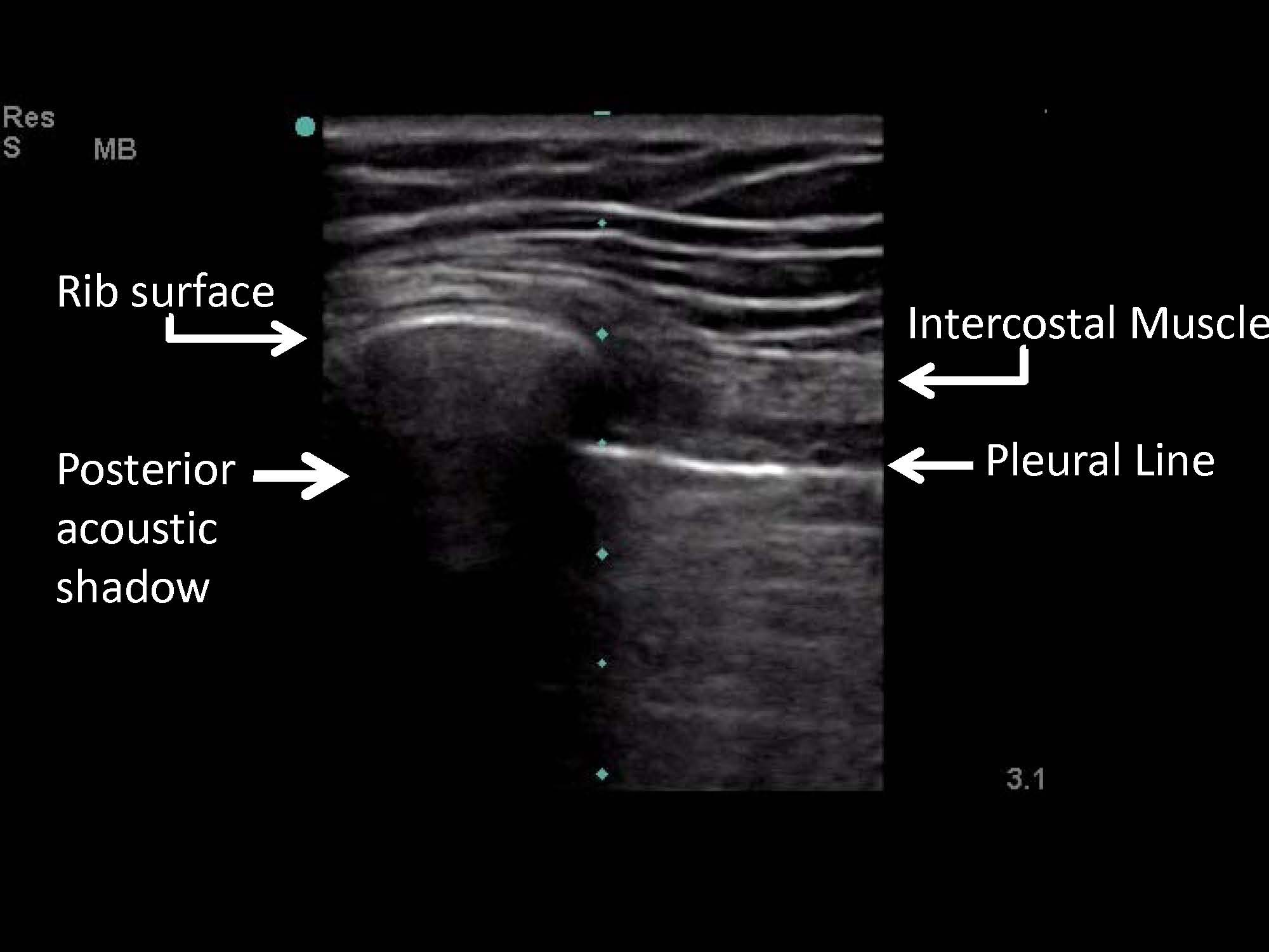 Thoracentesis, Pleural Biopsy, and Thoracic Ultrasound