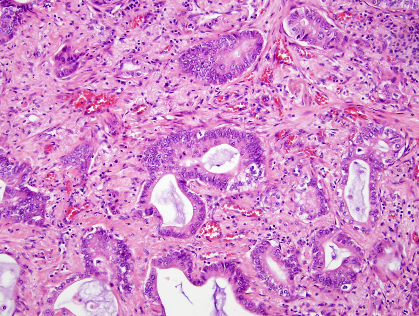 Non small squamous cell lung cancer