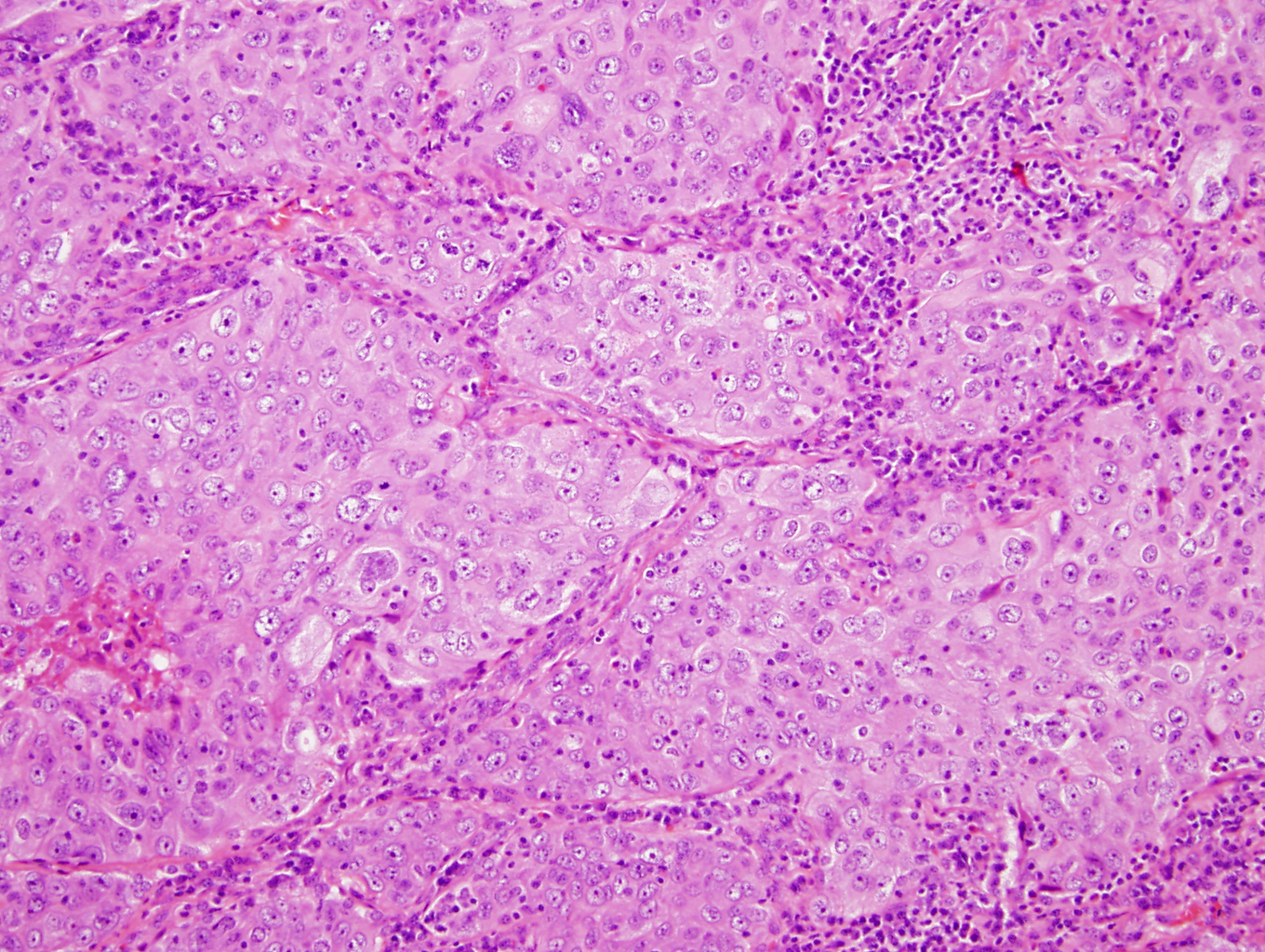 Non-small cell lung cancer