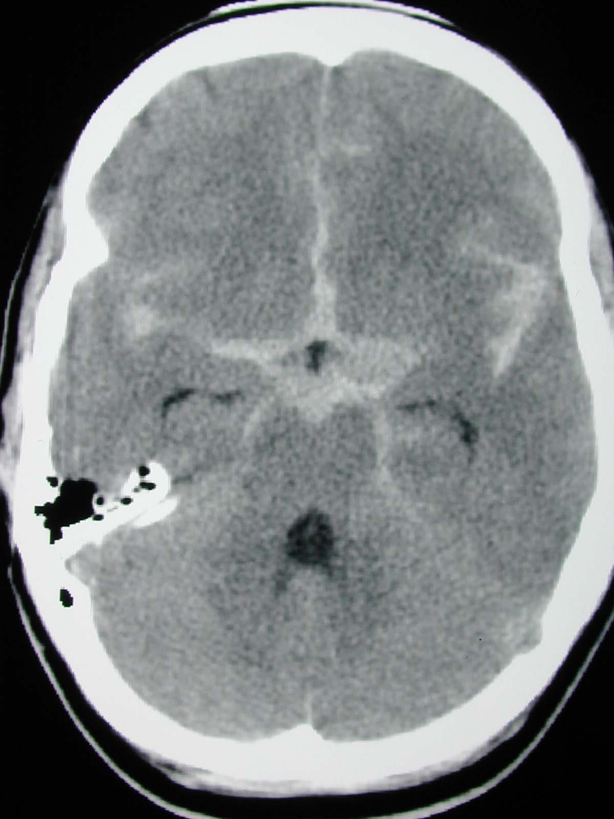 Subarachnoid Hemorrhage