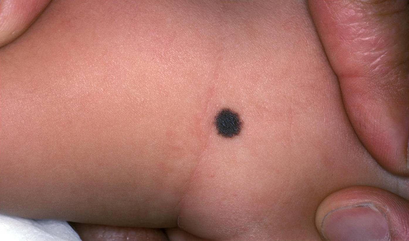 Common Birthmarks