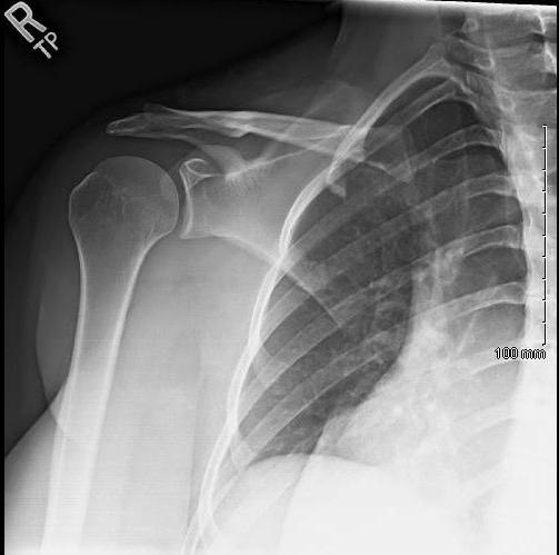 Adhesive Capsulitis: Evaluation and Management