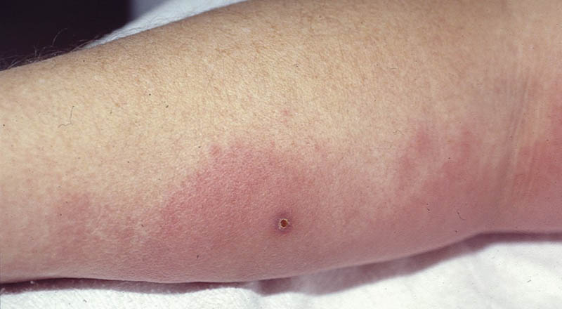 Cellulitis and Erysipelis