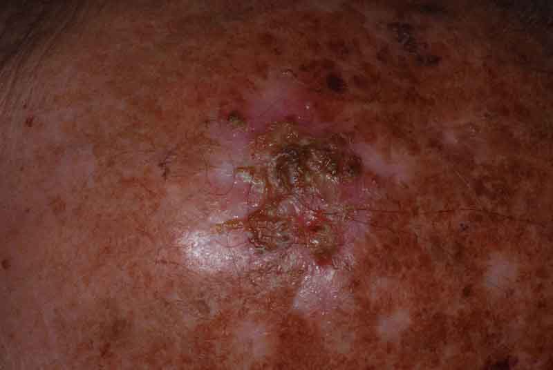 Erosive Pustular Dermatitis Of The Scalp (erosive Pustulosis Of The 