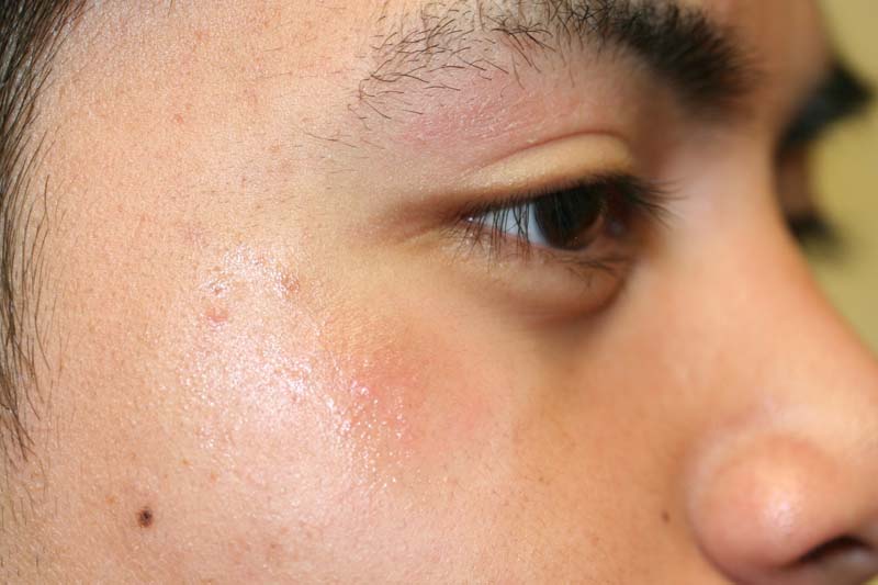 Eyelid Dermatitis (xeroderma of the eyelids, eczema of the eyelids ...