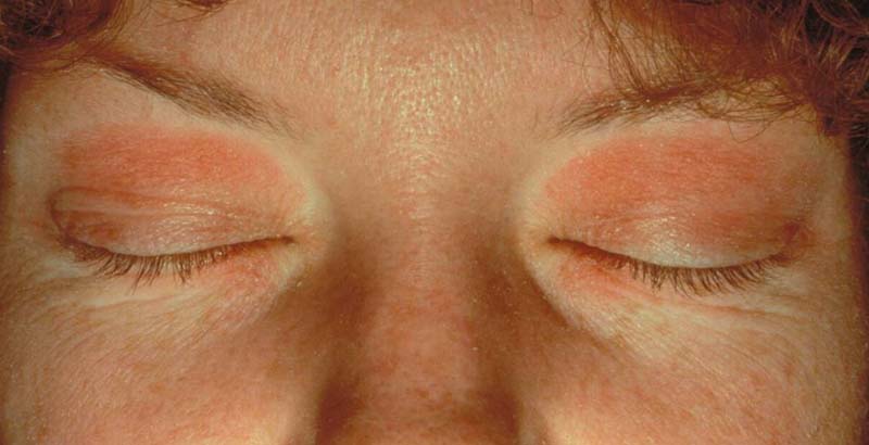 Eyelid Dermatitis Xeroderma Of The Eyelids Eczema Of The Eyelids Atopic Dermatitis Allergic 